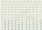 ECG 上の心房粗動：原因、臨床症状 ECG 上の心房細動の兆候
