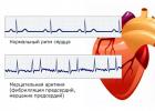 What does atrial rhythm mean on an ECG?