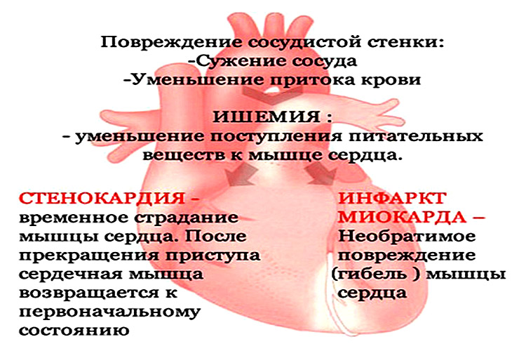 Причины боли сердца у мужчин. Покалывающие боли в области сердца.