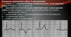 Normalt elektrokardiogram Negativ p-bølge