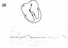 Atrioventricular nodal rhythm