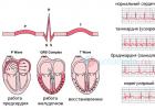 Diagnostic de l'infarctus du myocarde : signes cliniques et ECG, photo avec interprétation