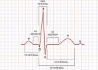心臓の心電図の解読